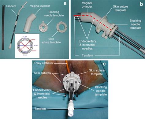 Interstitial preoperative high-dose-rate brachytherapy for early stage cervical cancer: Dose ...