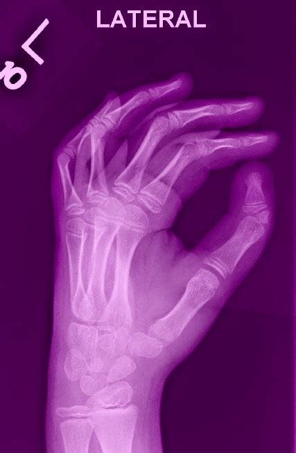 Triphalangeal Thumb | Congenital Hand and Arm Differences