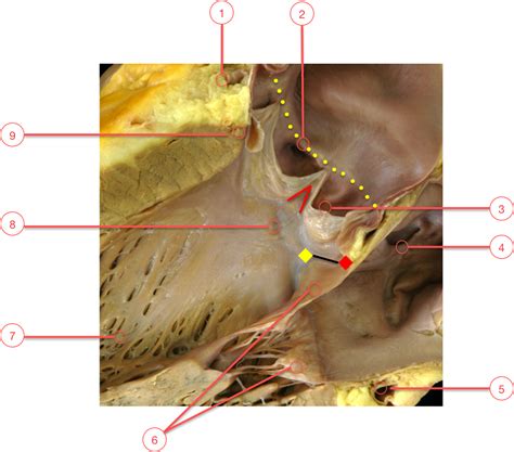 Aortic Valve Annulus