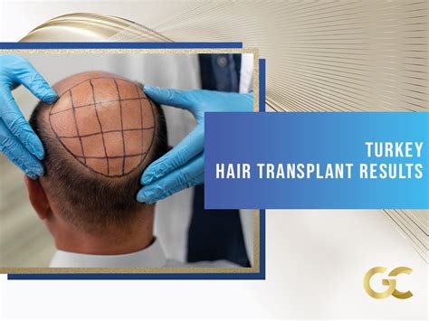 Turkey hair transplant results - Gold City Best Hair Transplant Turkey