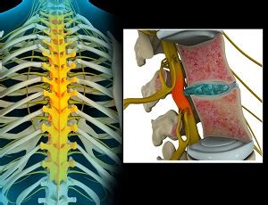 Thoracic Nerve Compression Harris County, TX | Spinal Compression ...