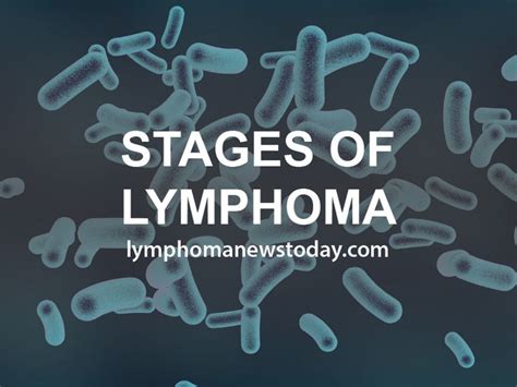 Stages of Lymphoma | Lymphoma, Lymphoma cancer, Hodgkins lymphoma