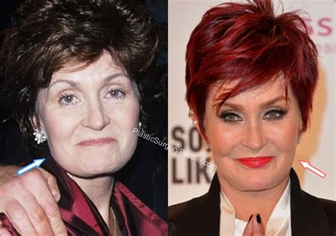 Sharon Osbourne: BEFORE and AFTER