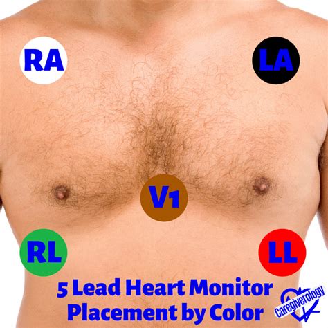 Holter Monitor 5 Lead Placement Diagram - Wiring Diagram