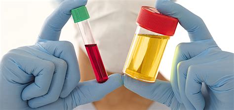 Hematuria: Causes, Symptoms And Treatment | Medcity Blogs