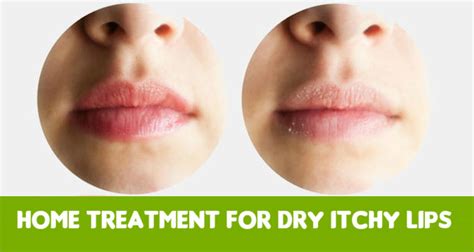 Efective Home Treatment for Dry Itchy Lips