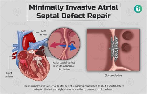 Minimally invasive atrial septal defect repair: Procedure, Purpose ...