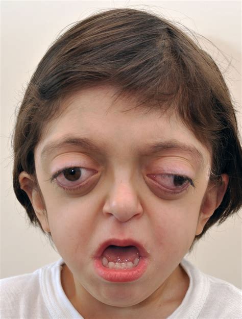 Crouzon syndrome is a condition in which sutures in the head are prematurely fused resulting in ...