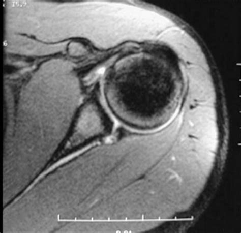 Labrum Injury