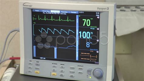 Medical EKG Heart Rate Monitor at Hospital ~ Footage #8983703