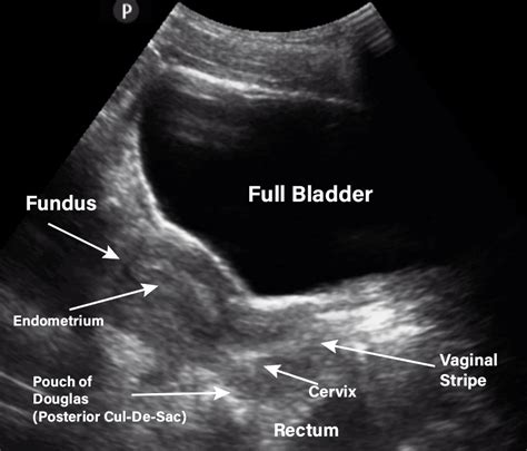 Gynecology/Pelvic Ultrasound Made Easy: Step-By-Step Guide | Ultrasound, Medical ultrasound ...