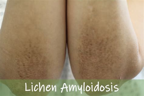 How to Treat Primary Cutaneous Lichen Amyloidosis Naturally | 247HealthBlog