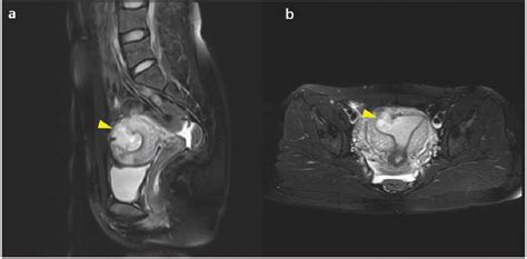 Figure 1 from Myomectomy scar pregnancy: a case report and review of the literature | Semantic ...