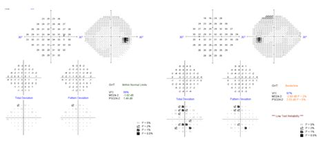 The Practical Approach to the Glaucoma Suspect