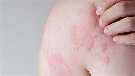 Urticaria and hives symptoms and causes | Pai Skincare UK