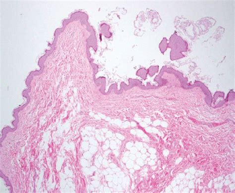 Acrochordon Histology