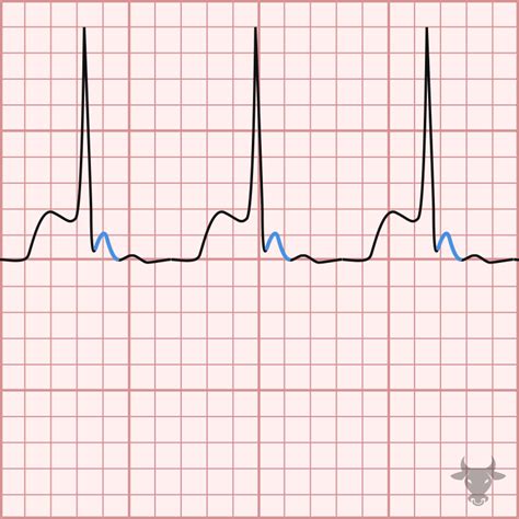 Atrioventricular Nodal Reentrant Tachycardia | ECG Stampede