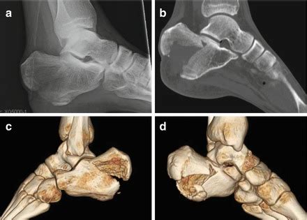 Tongue-Type Calcaneus Fractures | Musculoskeletal Key