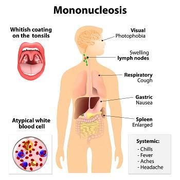 Treating Mono in Your Child