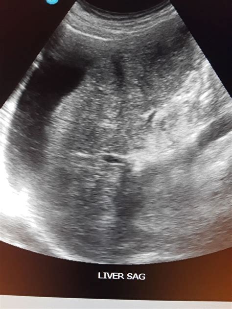 Liver cirrhosis with ascites | Ultrasound school, Ultrasound, Sonography