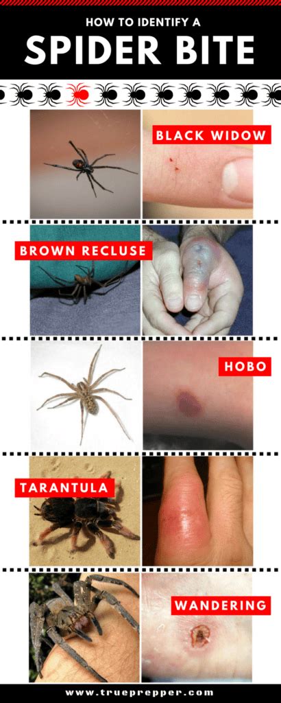 How to Identify a Spider Bite and Treat It - TruePrepper