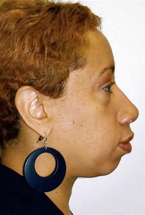 Maxillofacial Surgery | Facial Implants - Cleveland Cosmetic Surgery