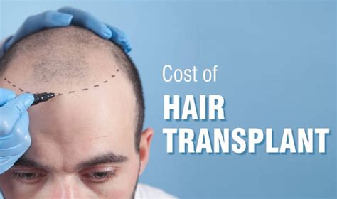 Hair Transplant Cost Guide | Updated 2022