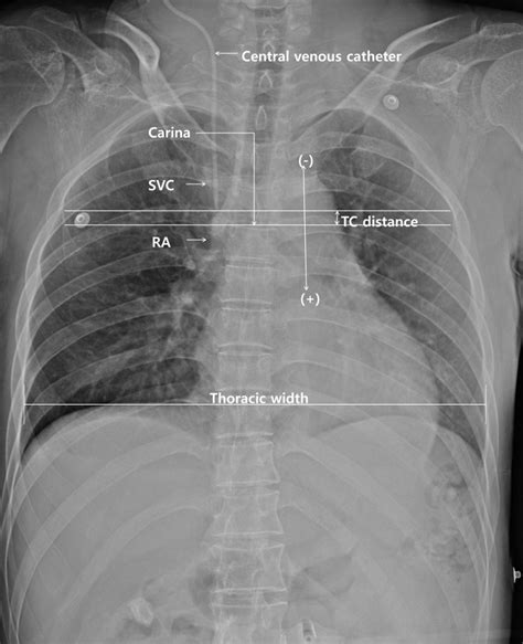 Evaluation Of Central Venous Catheter Insertion Using Chest X Ray In | My XXX Hot Girl