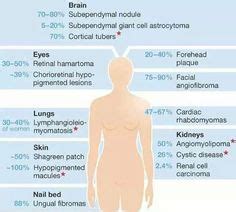 20 Best Tuberous Sclerosis ideas | tuberous sclerosis, genetic disorders, heart problems