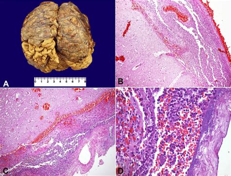 A-Gross appearance of the brain, showing thickened meninges with... | Download Scientific Diagram