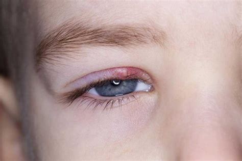 Topiclocal.com | Know about the Symptoms and Causes of Eyelid Inflammation