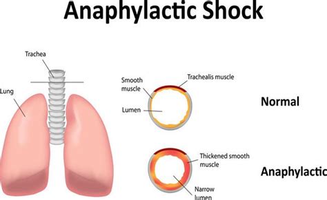 Anaphylactic Shock: Causes, Clinical Features, Signs, Symptoms