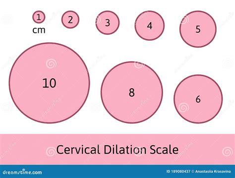 Cervix Dilation Chart Labor