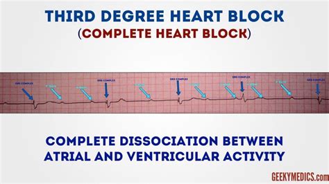 How to Read an ECG | ECG Interpretation | EKG | Geeky Medics