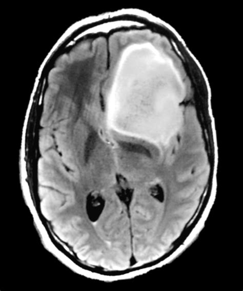 Top 102+ Images Brain Tumor Pictures Ct Scan Sharp