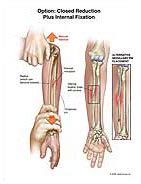 Medivisuals Option - Closed Reduction Plus Internal Fixation Medical ...