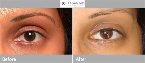 Eyelid Chalazion Surgery Before and After Gallery | Taban MD