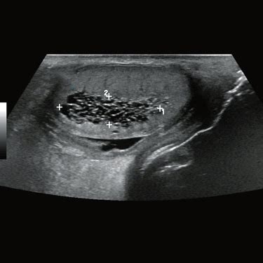 Mediastinum Testis Ultrasound