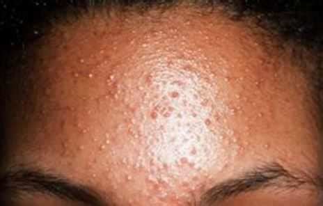 Bumps on Forehead, Small Spots, Get Rid of Little Hard Lump on Forehead, White Raised Heat Bumps ...