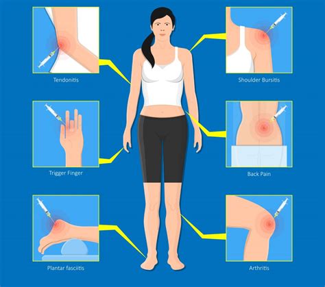 Cortisone Injections - My Family Physio