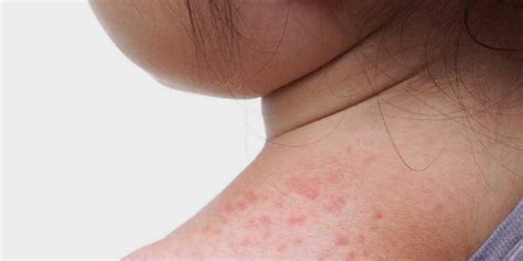 Suffering From Sweat Rashes? These Home Remedies Will Cure & Soothe You ...