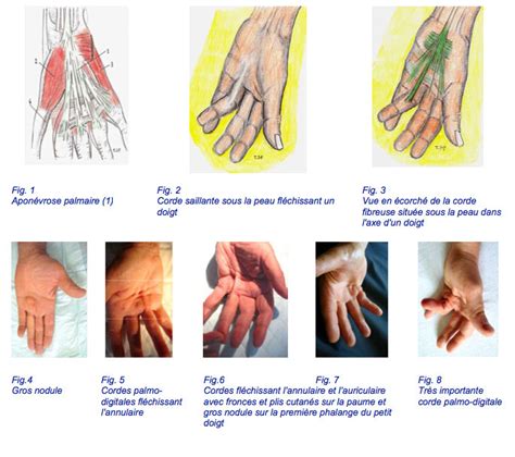 Traiter la maladie de Dupuytren sans opérer (aponévrotomie percutanée à ...
