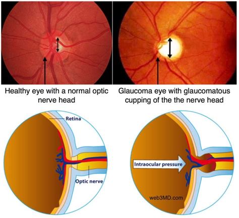 glaucoma-cupping-of-nerve-head-1024x932