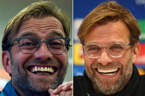 Jurgen Klopp Teeth Before And After / 5 Reasons Why Jurgen Klopp Will Lay The Smackdown on Your ...