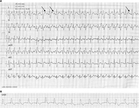 Figure 2 from Multifocal atrial tachycardia in 2 children. | Semantic ...