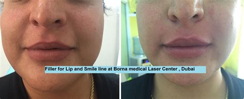 Filler for Lip and Smile line at Borna medical Laser Center , Dubai ...