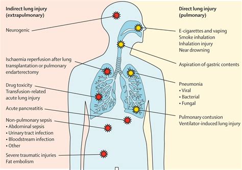 Acute respiratory distress syndrome: causes, pathophysiology, and ...