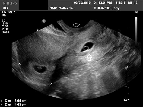 9 Week Ectopic Pregnancy Ultrasound