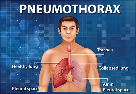 Best Treatment for Pneumothorax in Mumbai | Dr. Dhiraj Jain