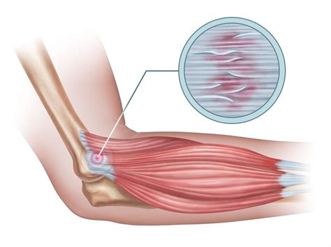 Tennis Elbow Causes, Symptoms & Treatment - Tennis Uni